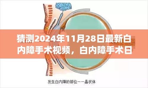 白內(nèi)障手術(shù)最新進展揭秘，溫馨之旅中的小驚喜，白內(nèi)障手術(shù)日精彩瞬間回顧（附最新視頻）